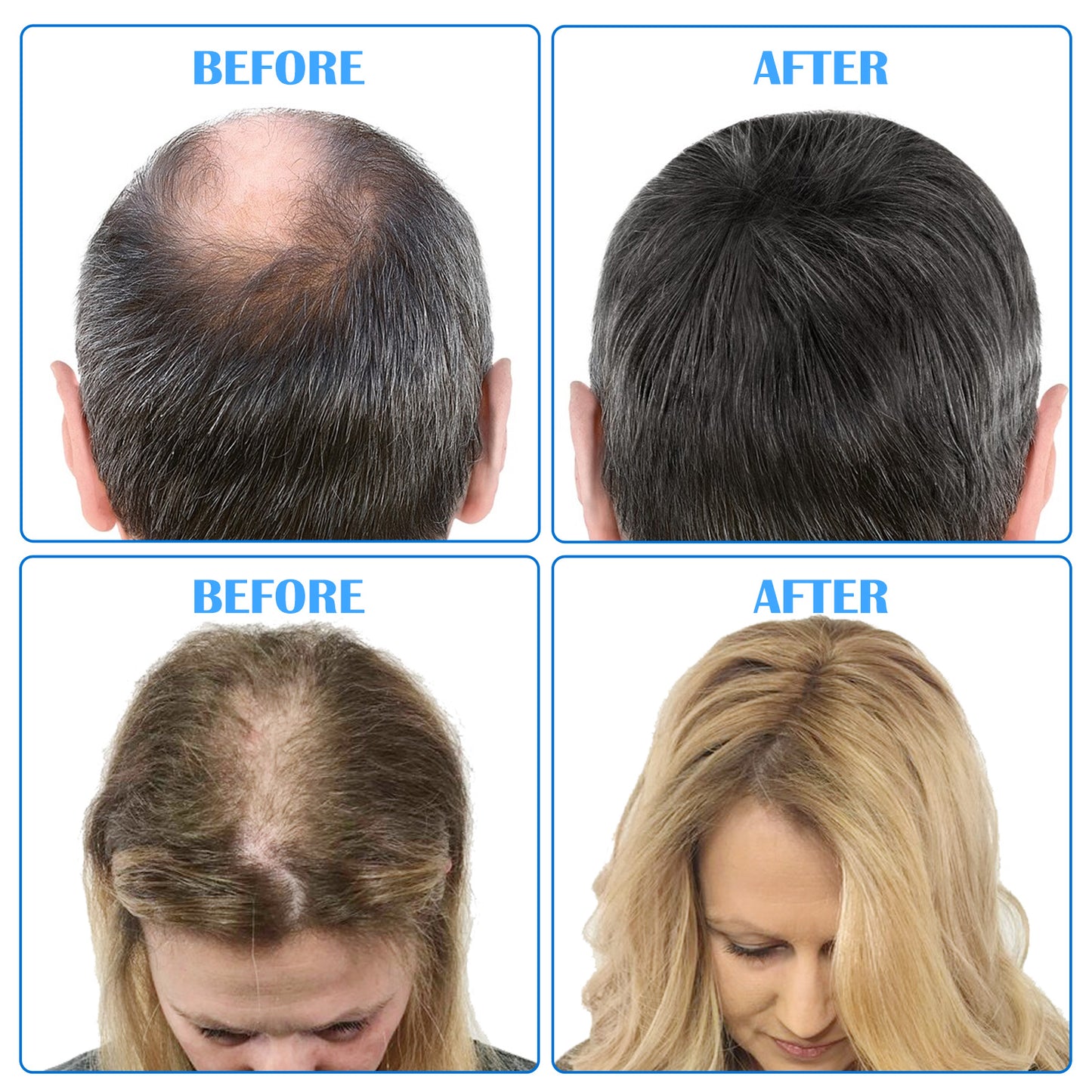 5% MINOXIDIL HAIR GROWTH SERUM FOR MEN
