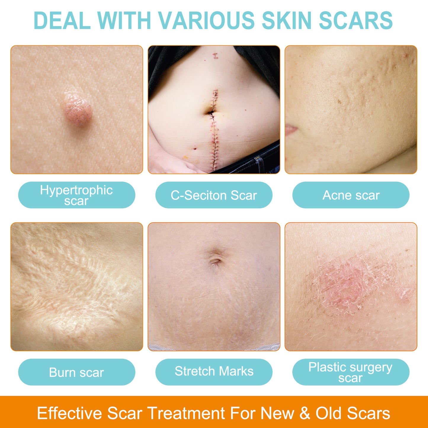 Scar Removal Tape