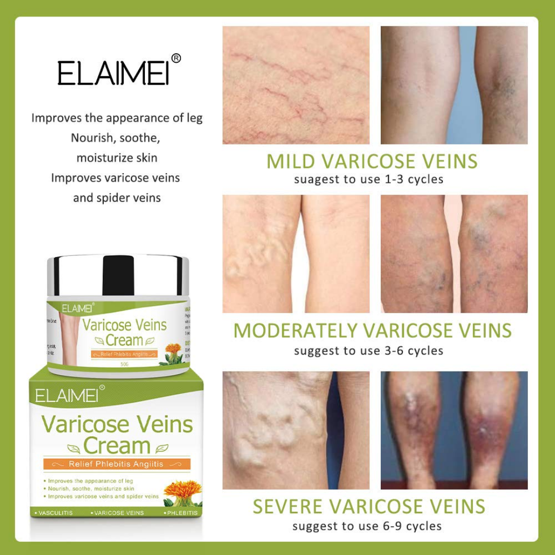 Varicose Veins Cream