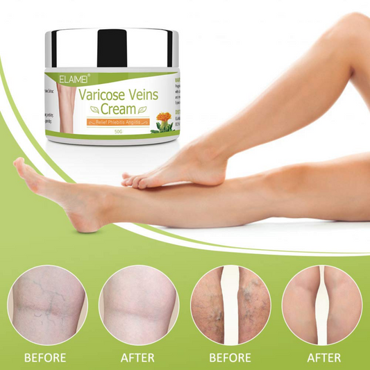 Varicose Veins Cream