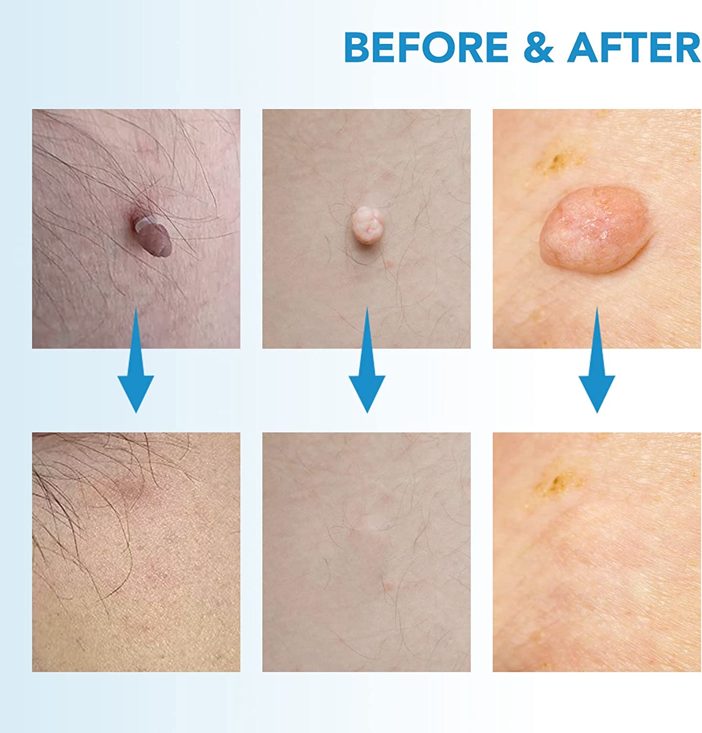 Skin Tag Remover Set